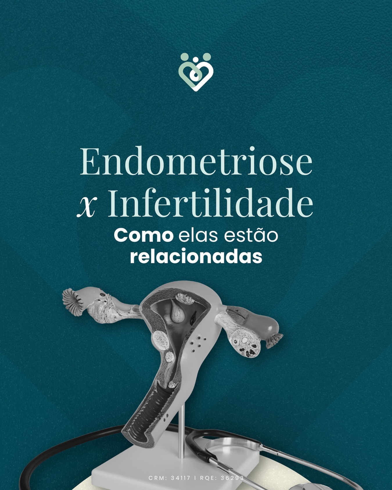 Endometriose x Infertilidade